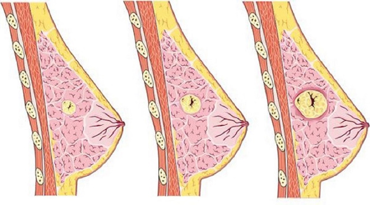 U vú lành tính có nên mổ không? Tìm hiểu khi nào cần phẫu thuật và khi nào nên theo dõi