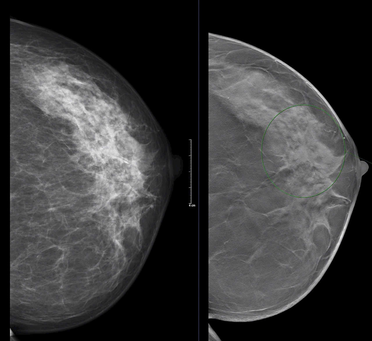 U tuyến vú có cần mổ không? Hiểu rõ bản chất u giúp điều trị đúng