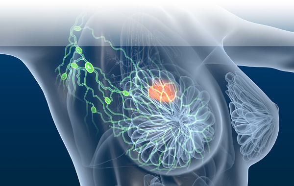 Ung thư vú bị tái phát: Nguyên nhân, dấu hiệu và cách điều trị
